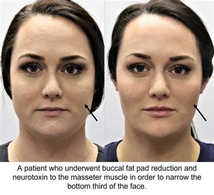 A Deeper Dive Into Buccal Fat Removal