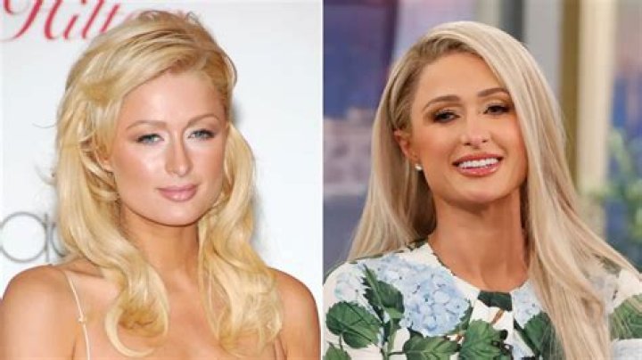 Paris Hilton's Cosmetic Journey Explored