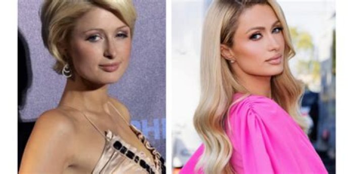 Paris Hilton's Nose Job: Uncovering The Enigma