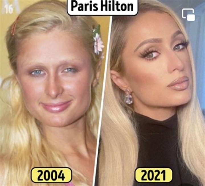 Paris Hilton's Nose Transformation And Its Impact