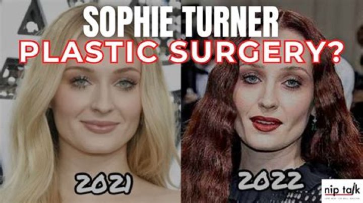 Sophie Turner's Plastic Surgery: Unlocking The Truth
