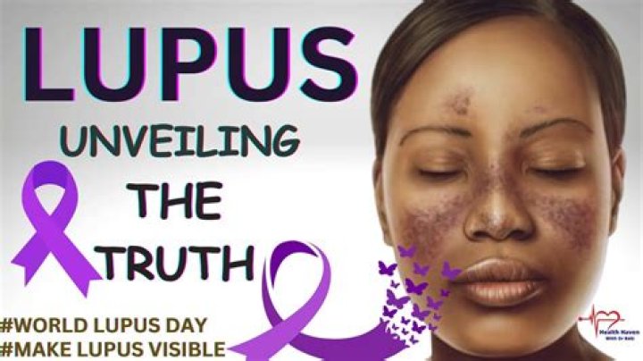 Unveiling The Truth About Lupus