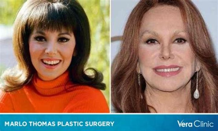 Unveiling The Truth Behind Marlo Thomas's Plastic Surgeries